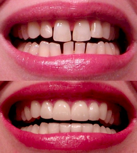 Filing+teeth+before+and+after